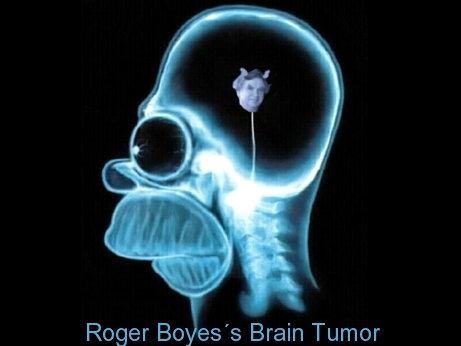 Boyes' tumor
